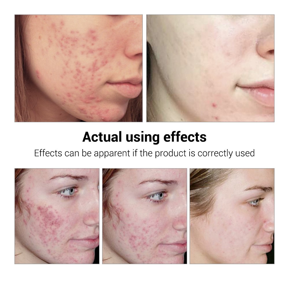 Breylee Acne Serum - Bye to Acne and Breakouts